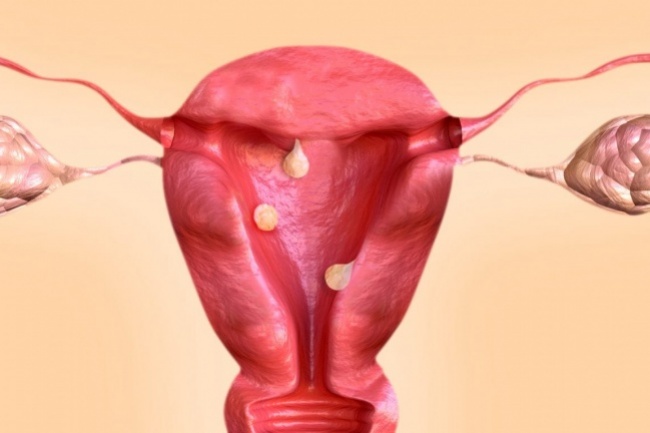 Biópsia Endometrial